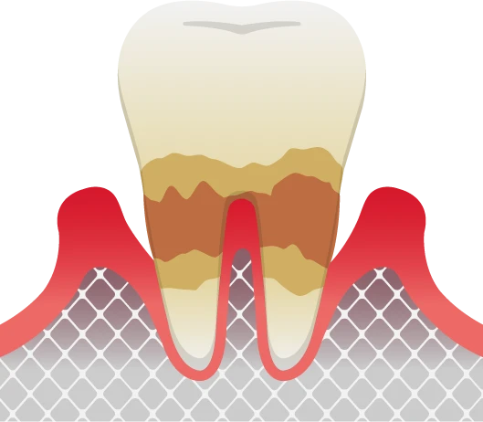 虫歯の前兆